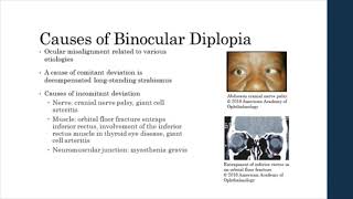 Binocular vs Monocular Diplopia [upl. by Edan]