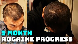 3 Month Rogaine Results and Progress Minoxidil [upl. by Nahta]