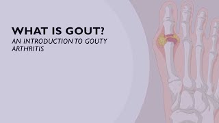 Acute Gout Treatment  How You Can Relieve the Sudden Onset of Pain 5 of 6 [upl. by Judi]