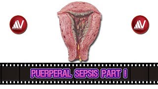 Puerperal Sepsis Part I [upl. by Eruot229]