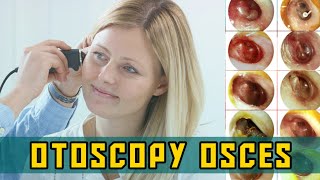 OTOSCOPY OSCEs  PLAB Image Reference [upl. by Wivinah]