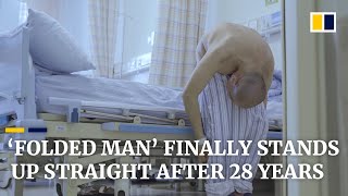 ‘Folded man’ stands up straight after 28 years following surgery that broke bones [upl. by Alfonso895]