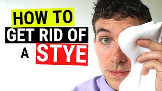 How to Get Rid of a Stye FAST  Chalazion VS Stye Treatment [upl. by Imim]