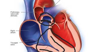 Pulmonary Stenosis [upl. by Sacha23]