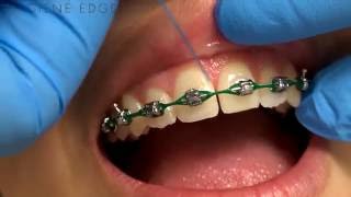 Flossing Braces With a Threader [upl. by Arihaj]