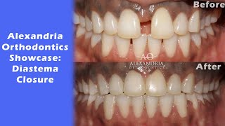 Alexandria Orthodontics Showcase Diastema Closure [upl. by Phillane]