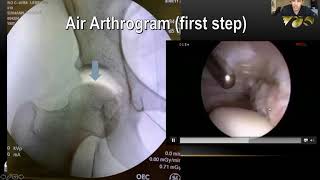 Femoroacetabular Impingement FAI [upl. by Atolrac]