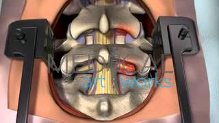 3D Medical Animation  Lumbar spine surgical procedure 2 level fusion of L4S1 [upl. by Liamaj]