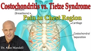 Costochondritis vs Tietzes Syndrome Pain in Chest Region  Dr Mandell [upl. by Concepcion556]