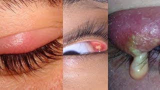 What is an Internal Stye [upl. by Wiley350]