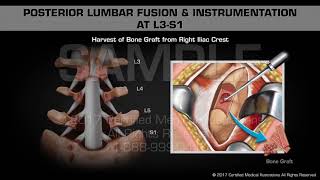 Posterior Lumbar Fusion amp Instrumentation at L3S1 [upl. by Cristen]