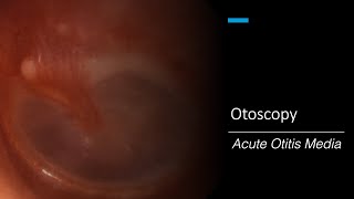 Acute Otitis Media Otoscopy [upl. by Ahsenahs]