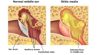 Otitis Media [upl. by Plank]