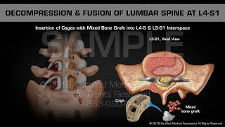 Post Hernia Repair Nerve Pain Complications [upl. by Norac]