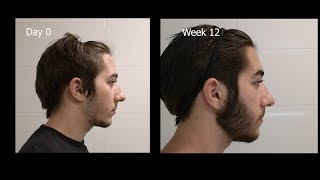 Minoxidil Beard Growth  3 Month Transformation  Timelapse BEFORE and AFTER [upl. by Capriola373]