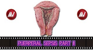 Puerperal Sepsis Part II [upl. by Yaner]