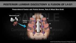 Posterior Lumbar Discectomy amp Fusion of L4S1 [upl. by Nereids]