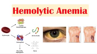 Hemolytic Anemia [upl. by Frantz]