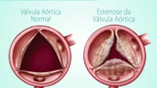 Estenose Aórtica saiba mais [upl. by Eerok]