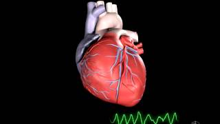 Ventricular Fibrillation ECG  EMTprepcom [upl. by Kolodgie]