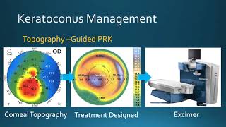 Keratoconus Management Corneal Crosslinking amp TopographyGuided PRK at Bochner Eye in Toronto [upl. by Lak]