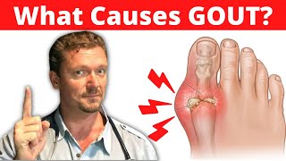 Gout Visual Explanation for Students [upl. by Glasgo187]