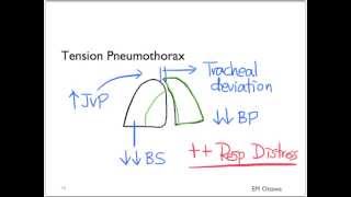 Pneumothorax Part 1 [upl. by Gile]