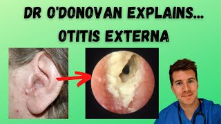 Explaining Otitis Externa  With Dr ODonovan [upl. by Muslim]