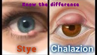 Difference between Stye and Chalazion [upl. by Yditsahc]