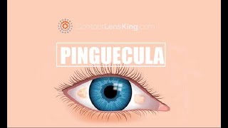 Pinguecula Causes Treatments and Prevention [upl. by Janelle]