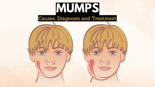 Mumps Causes Signs and Symptoms Diagnosis and Treatment [upl. by Akehsay645]