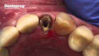 Emergency Repair of Loose Crown [upl. by Wilone]