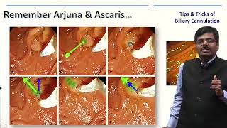 ERCP Masterclass  Tips And Tricks of Selective Biliary Cannulation [upl. by Oznole266]