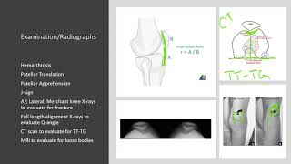 Patella Instability [upl. by Christoforo]