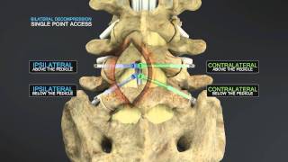 Medical Animation of Lumbar Stenosis Decompression [upl. by Adai731]