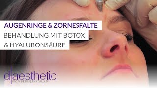 Augenringe Zornesfalte und Krähenfüße  Behandlung mit Hyaluronsäure und Botox  daesthetic [upl. by Svoboda]