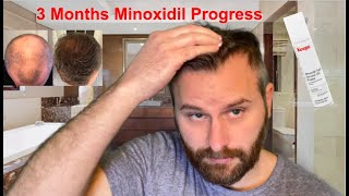 3 Months Results With Minoxidil Generic Rogaine  What You Can Expect [upl. by Larret]