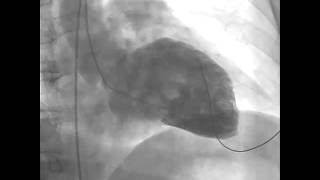 Normal Heart vs Heart in AFib [upl. by Finn]