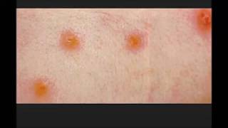 Chiggers simple facts You should know [upl. by Sowell992]