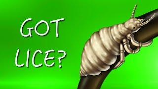 How to find head lice early [upl. by Pulling721]