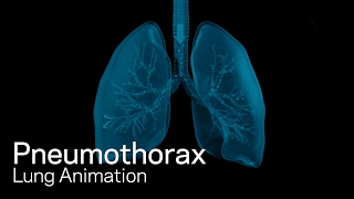 Pneumothorax [upl. by Line]