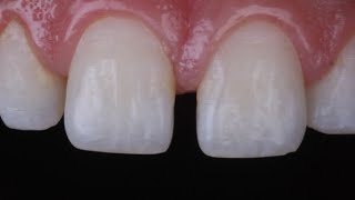 diastema closure with composite resin [upl. by Lola]