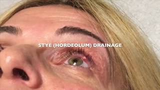 Draining a Stye Hordeolum on the left eye [upl. by Arehs162]