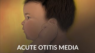 Acute Otitis Media by A Ruan J Cheng  OPENPediatrics [upl. by Kenny362]