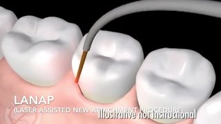 How Does Laser Surgery Work Treat Gum Disease  LANAP [upl. by Esidnak]