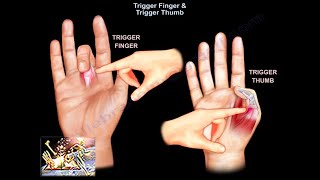 Trigger Finger amp Trigger Thumb  Everything You Need To Know  Dr Nabil Ebraheim [upl. by Ardnuhs991]