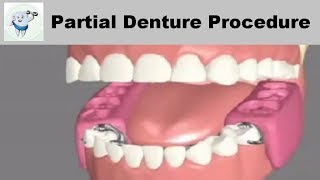 Removable Partial Dentures Steps [upl. by Nole]