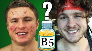 Vitamin B5 The Secret To Clearing Acne [upl. by Ellinnet]