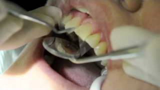 Teeth Bonding  Teeth Bonding Procedure [upl. by Teyugn]