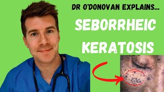 Explaining Seborrheic Keratosis  With Dr ODonovan [upl. by Severen465]